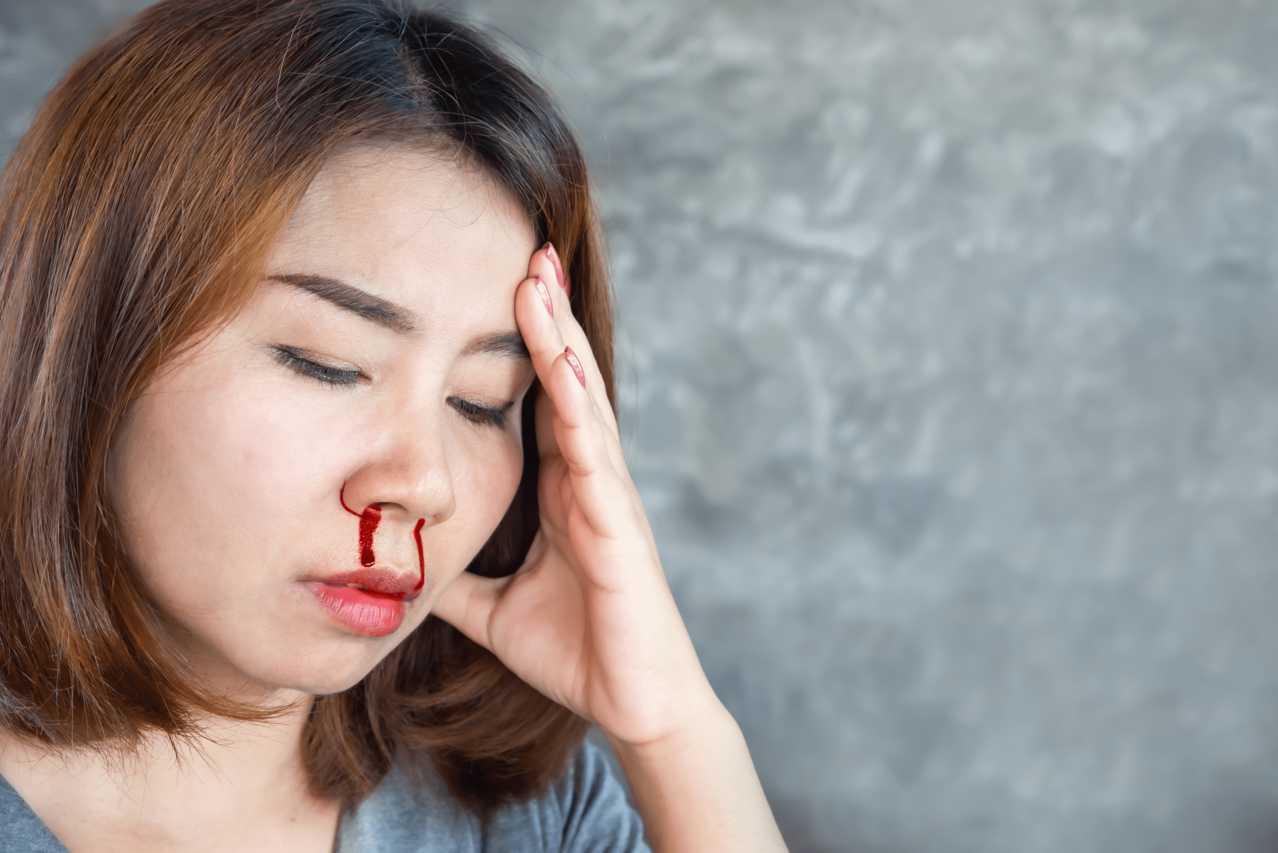 Woman holding head while her nose if bleeding.